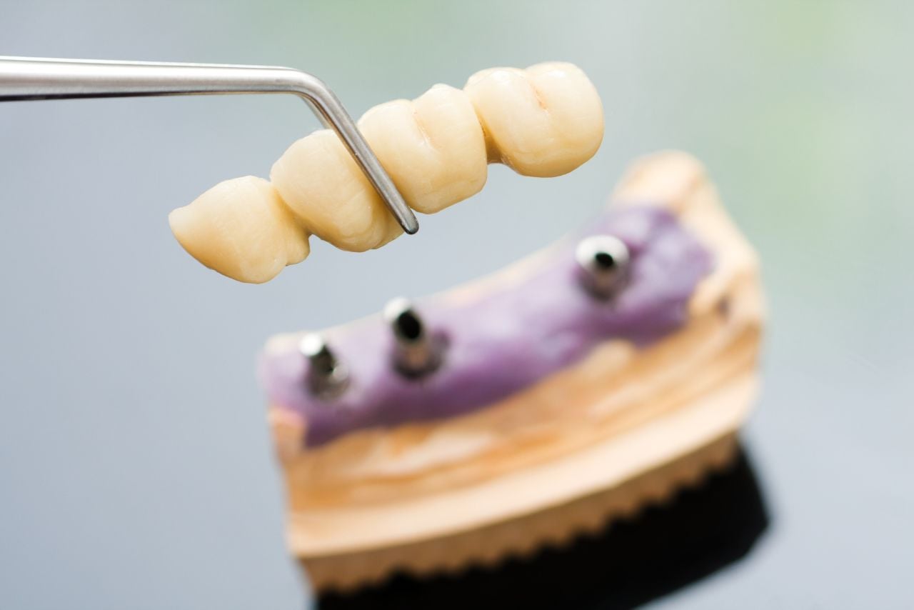 Dental Bridges