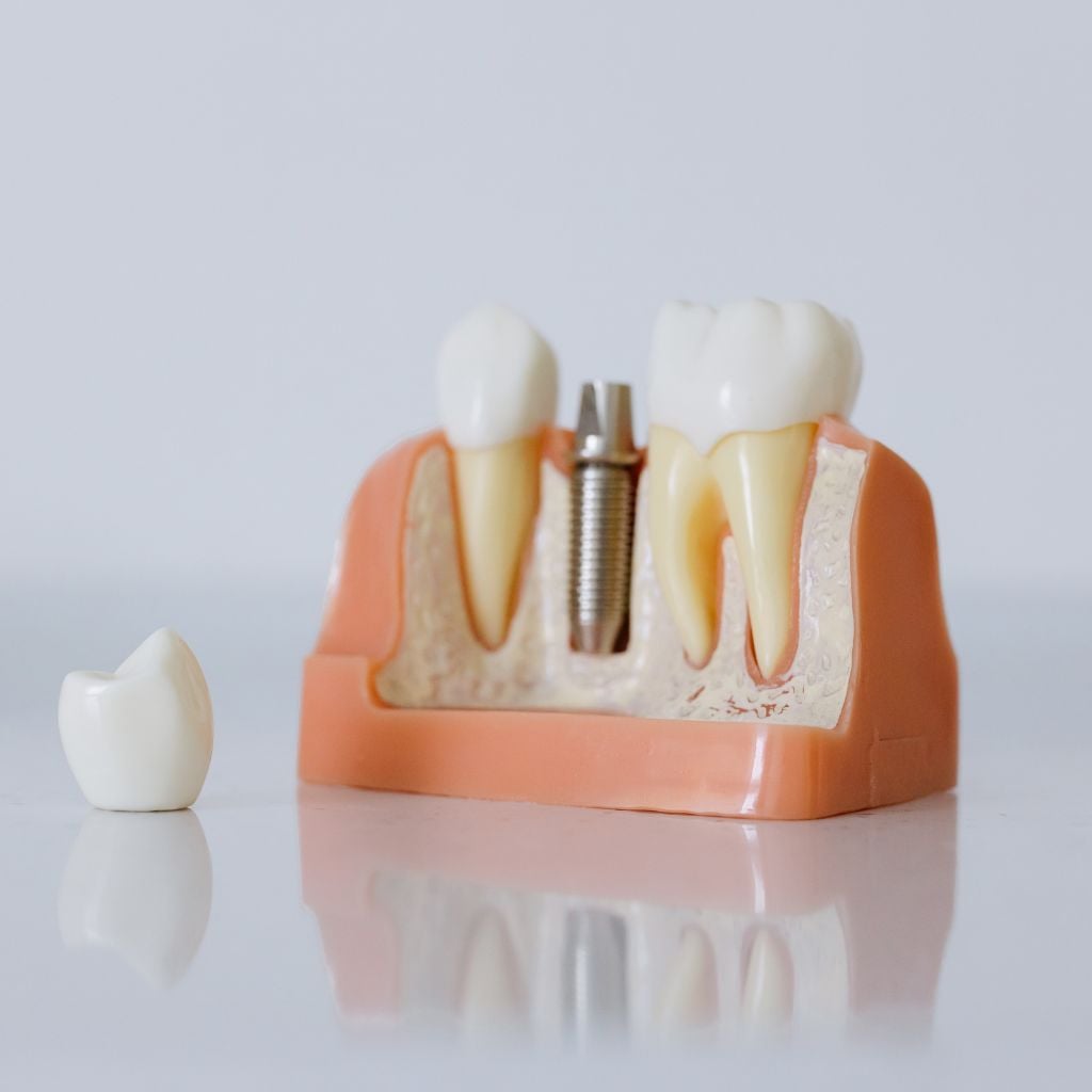 Comfortable Full Arch Implants Patient Experience