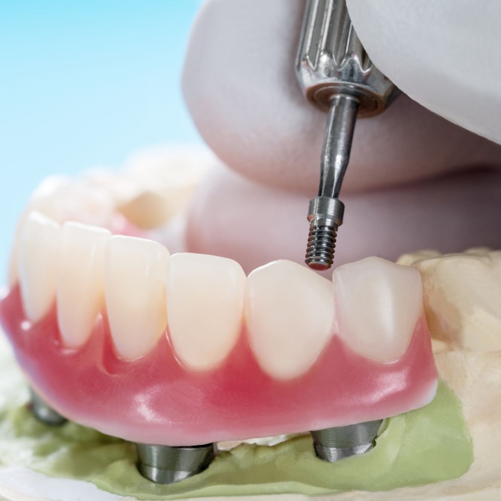 Comfortable Implant Supported Dentures Patient Experience