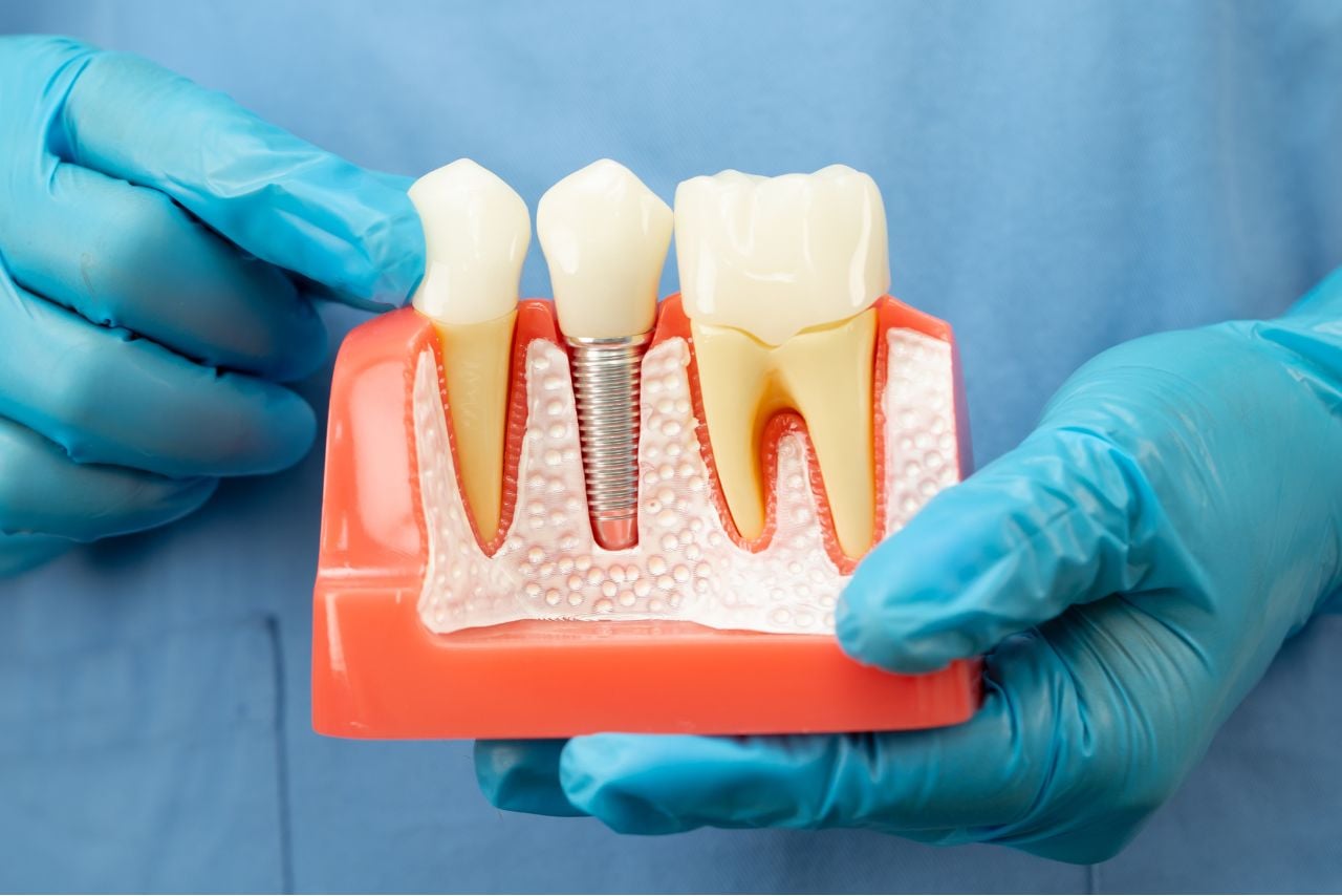 Single Tooth Implants