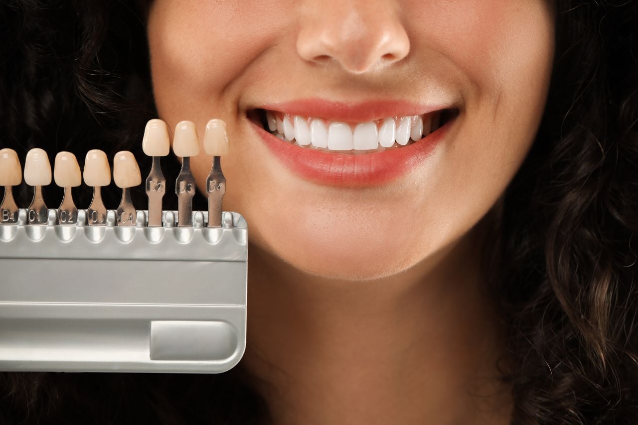 Veneers