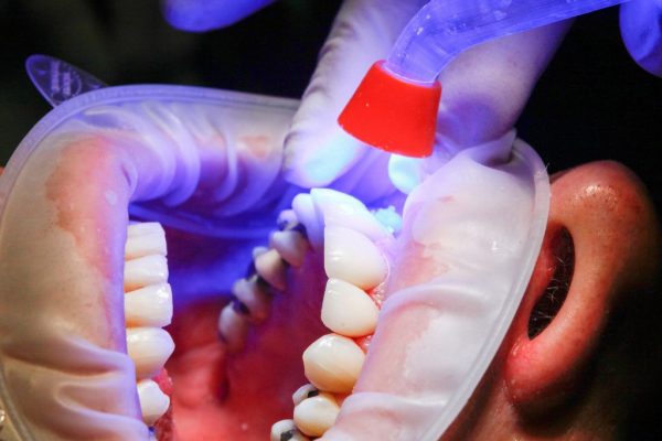 Fillings