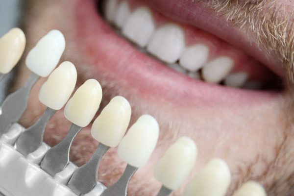 Veneers