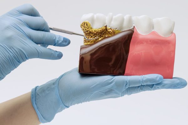 LANAP & Periodontal