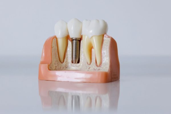 Dental Implants